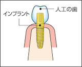 implant_p01